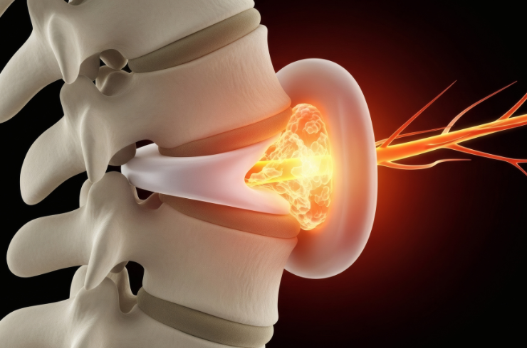 Radiculopathy